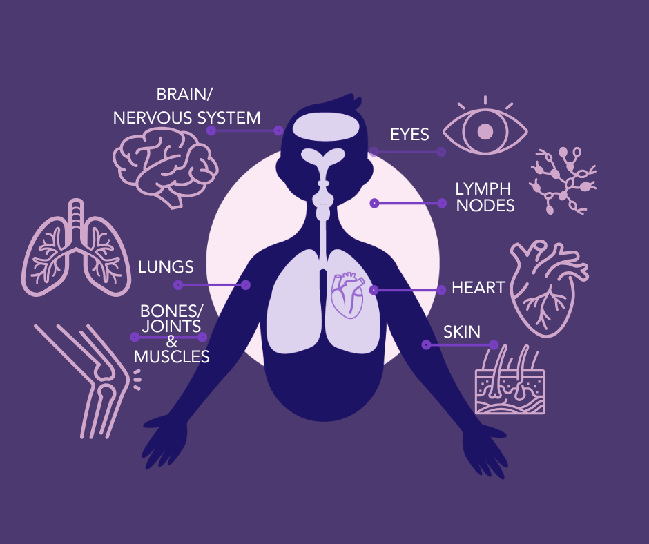 FACTS about Sarcoidosis for Awareness month (4)
