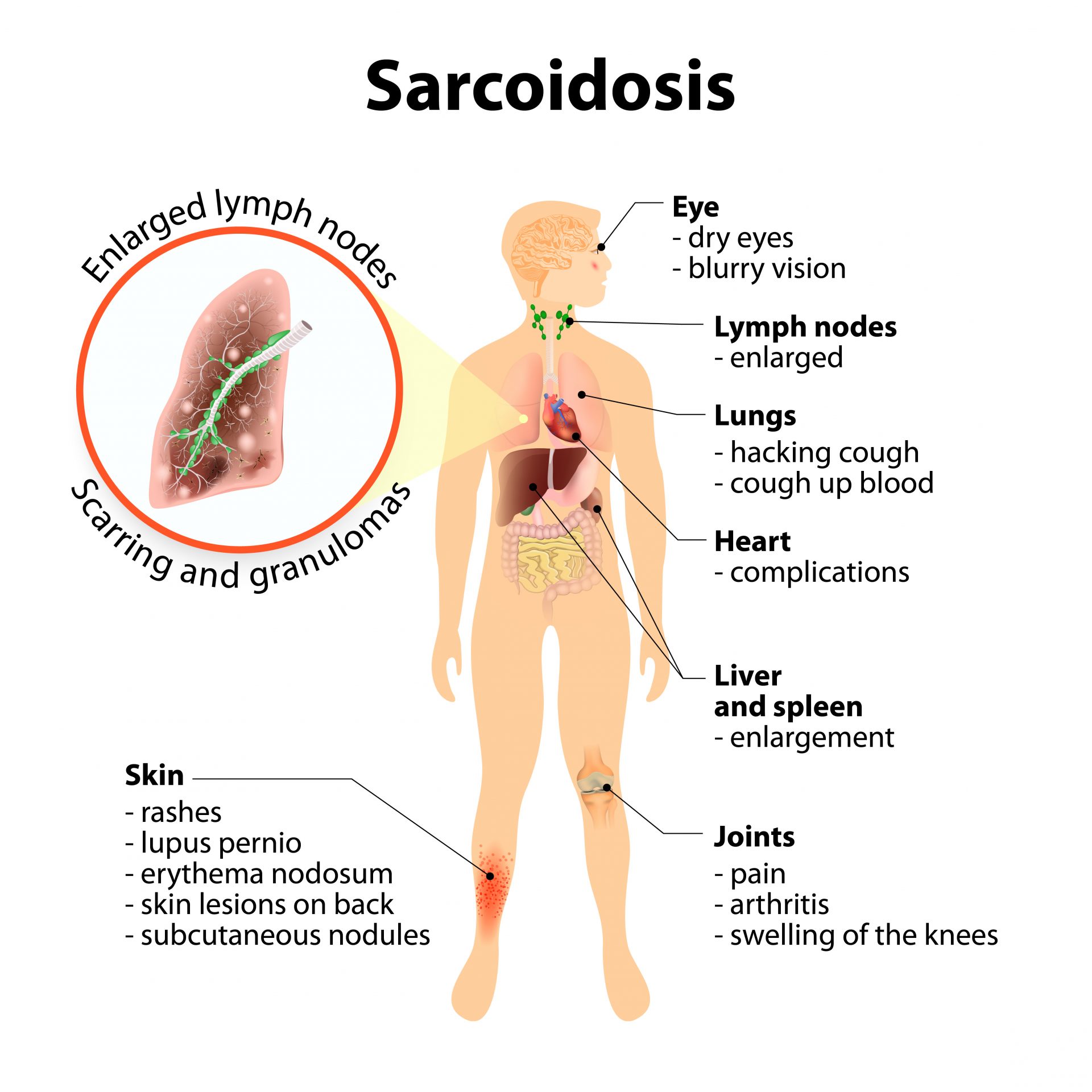 sarc symptoms