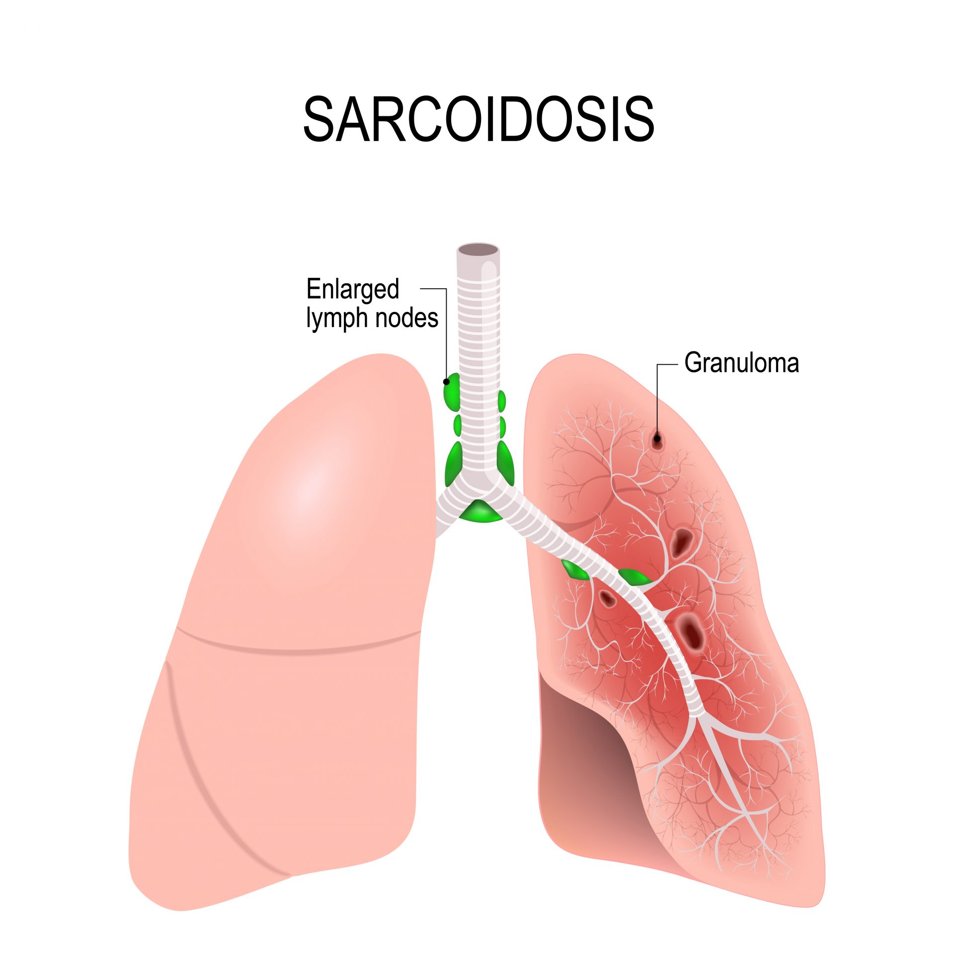 sarcoidosis in lungs