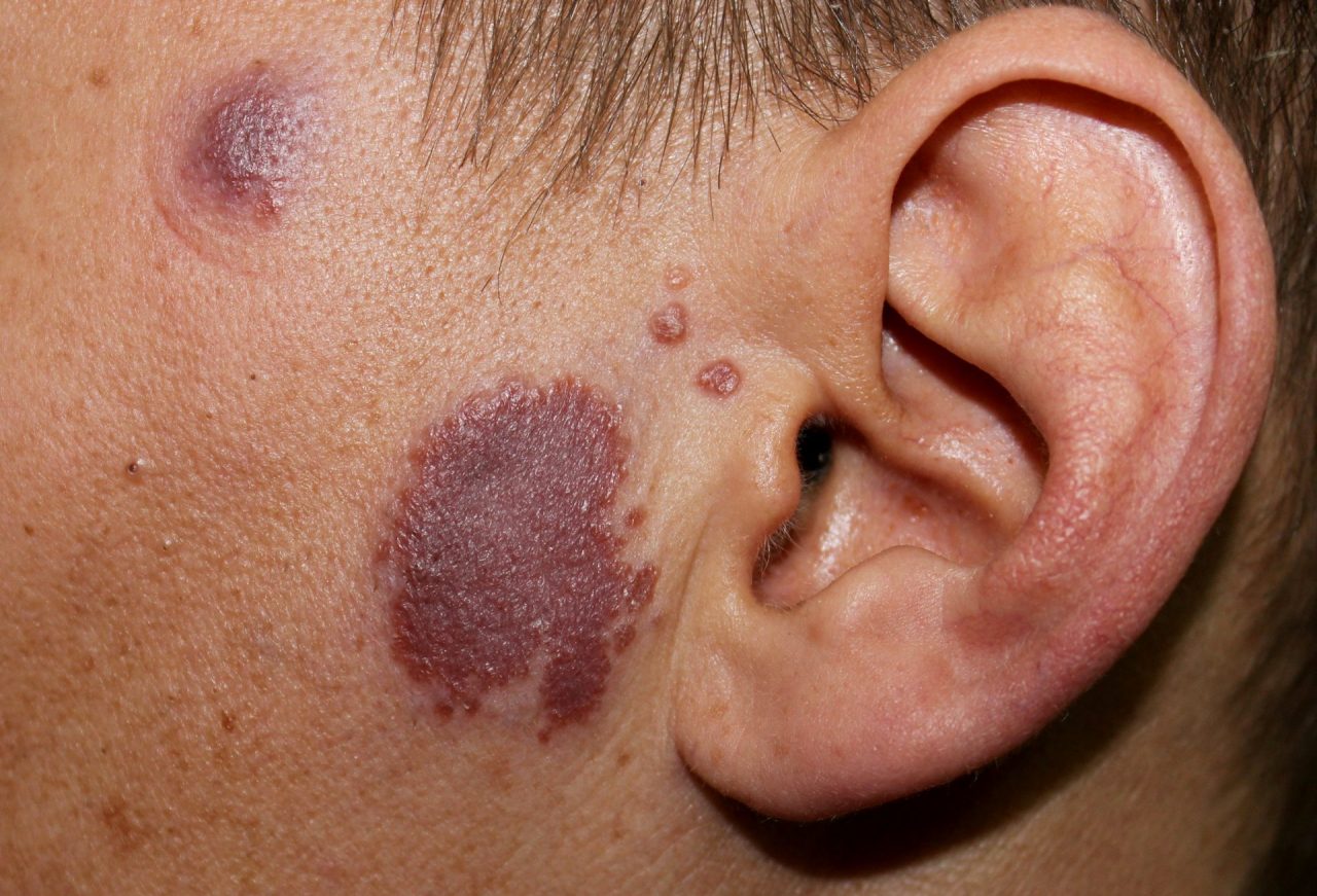 Sarcoidosis of the Skin (Cutaneous Sarcoidosis) — Foundation for ...